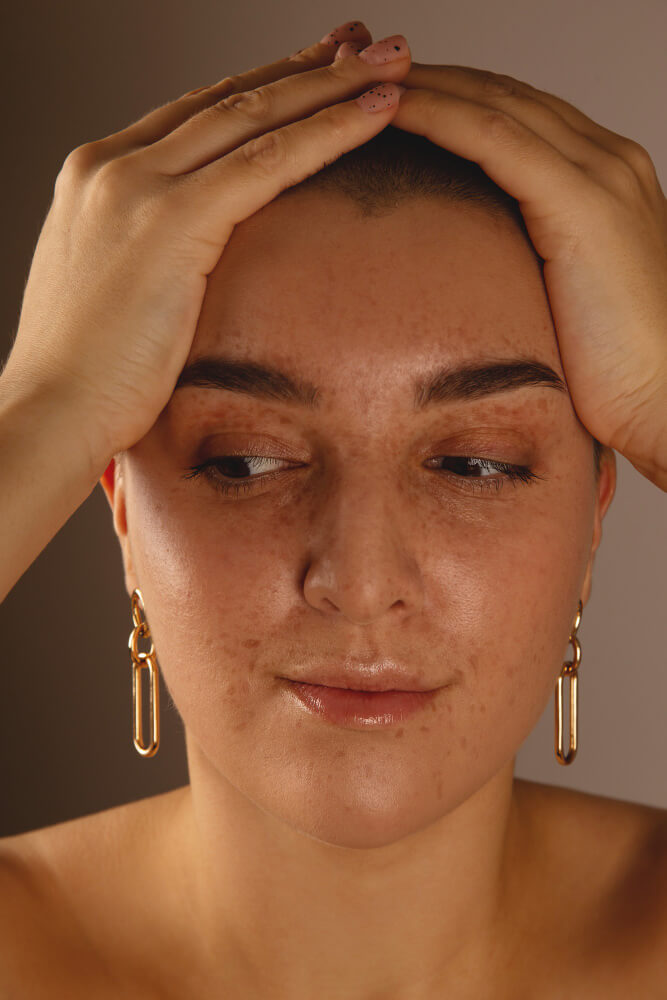 Microneedling profesional en Sevilla